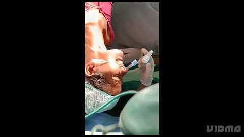 Airway blocks and Blind nasal intubation