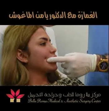 شرح عملية الغمازة مع د يامن الماغوش في مركز بيلاروما شرح عملية الغمازة مع د يامن الماغوش في مركز بيلاروما