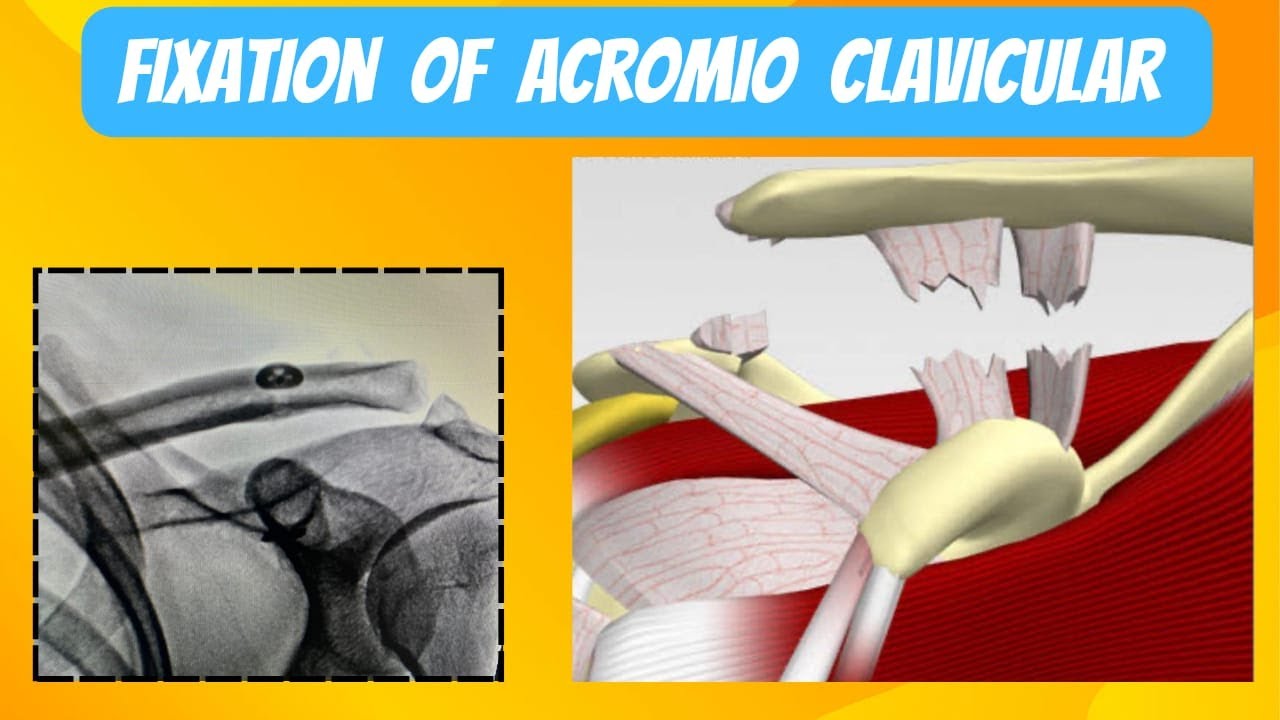 Percutaneous Incision AC JOINT FIXATION WITH ARTHEX KNOTLESS OPEN REPAIR DEVICE WITH SMALL ...