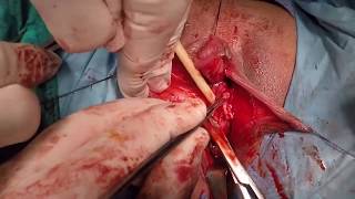 Операция по СМЕНЕ ПОЛА+18(Из ЖЕНЩИНЫ в МУЖЧИНУ) Операция по СМЕНЕ ПОЛА+18(Из ЖЕНЩИНЫ в МУЖЧИНУ)