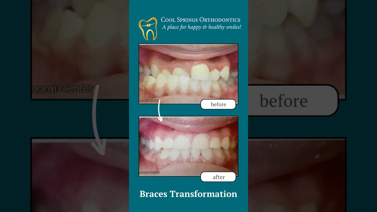 Before and After: More Than Just a Smile Transformation