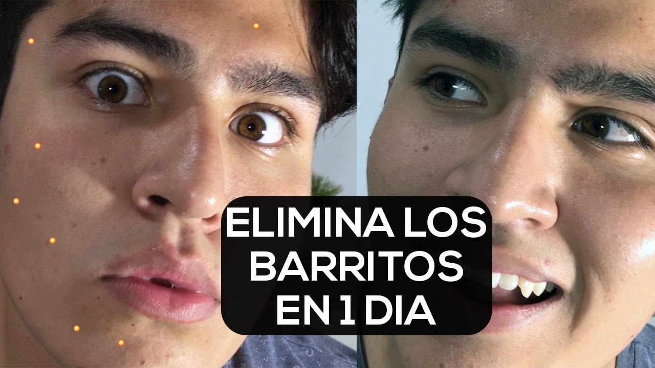COMO QUITAR LOS GRANOS DE LA CARA EN UN DIA PARA SIEMPRE