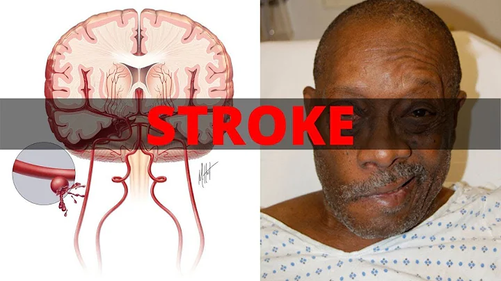 Assessment and Treatment of Stroke - DayDayNews