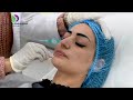 تعرفي على التقشير البارد و المعلومات التي يجب ان تتبعيها في المنزل تعرفي على التقشير البارد و المعلومات التي يجب ان تتبعيها في المنزل