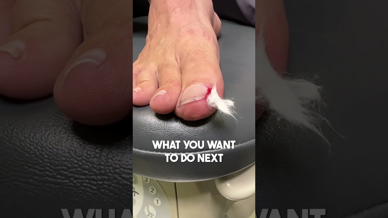 Как лечить вросший ноготь на ноге 🦶