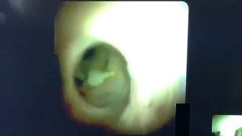 Direct visualization biopsy of a bile duct stricture using SpyGlass DS Cholangioscopy
