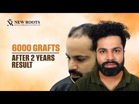 This Hair Growth After 2 Years Is Incredible! 🤯 | 6000 Grafts | Hair Transplant in Pune | Marathi