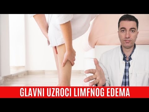 Video: Cervikalna Osteohondroza - Simptomi, Zdravljenje, Vaje, Masaža, Znaki