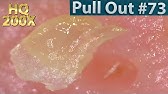 5 Scalp Hairline Blackhead Removal Close Up Hq0x 頭皮 生え際 の角栓をピンセットで除去 Youtube 5 Scalp Hairline Blackhead Removal Close Up Hq0x 頭皮 生え際 の角栓をピンセットで除去 Youtube