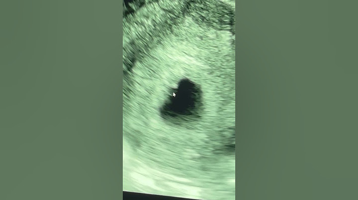 아기집 확인😭 심장 뛰는거 확인😍 #임신초기 #초음파 #임신초음파 #임신극초기 #6주2일 #심장 #임신 저렇게 팔딱이는게 심장이라고 들은날😭눈물찔끔