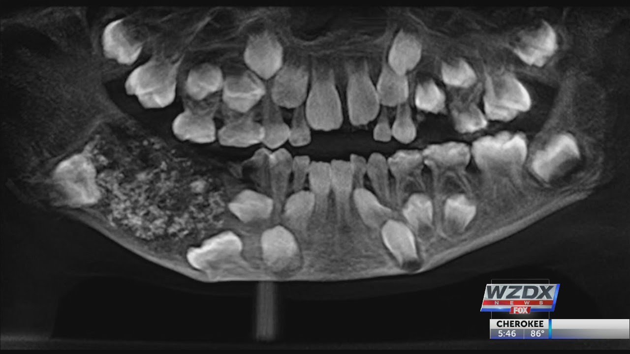 Too many teeth! YouTube