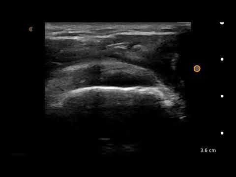 Image of Rotator Cuff SAX: Ultrasound Image Interpretation: