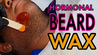 Thick Hormonal Beard Wax (Short Hair) #Hirsutism #Beard #ChinWax screenshot 5