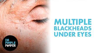 Multiple Blackheads Under the Eyes Safely Removed by Dr Pimple Popper Update