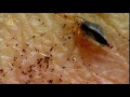 Нательная вошь (Pediculus corporis) под микроскопом