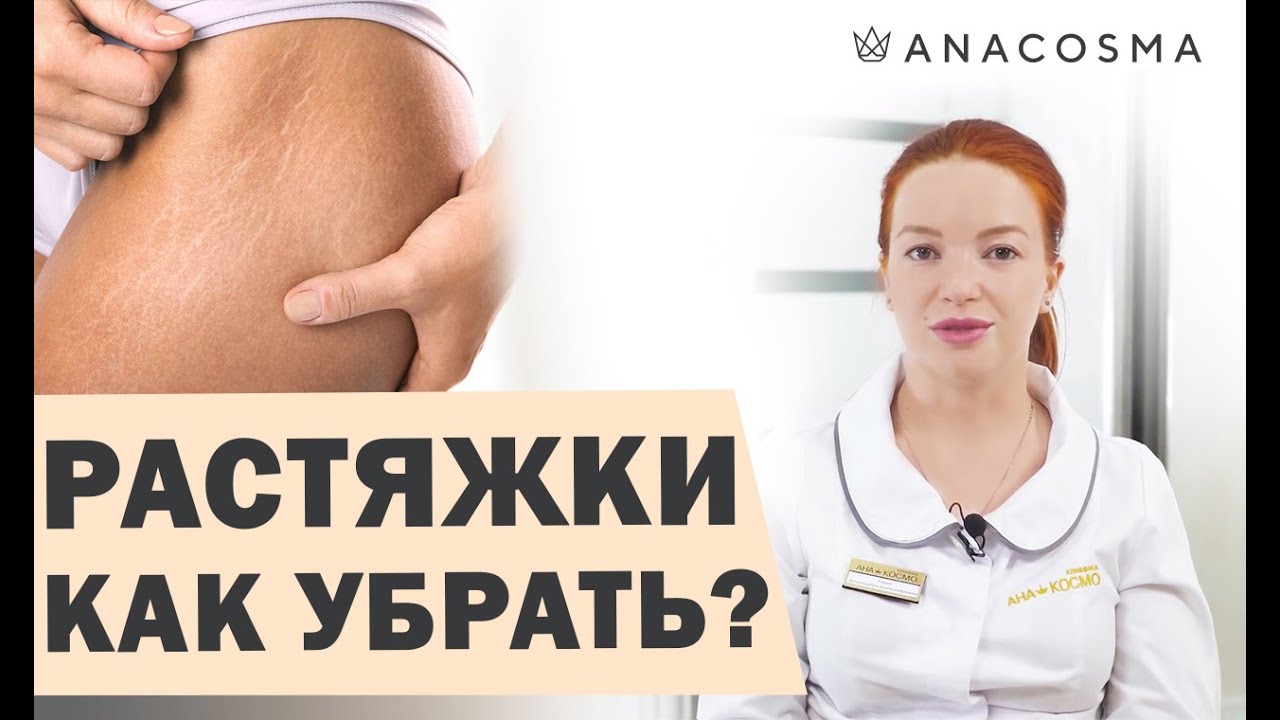 Как убрать растяжки и стрии?