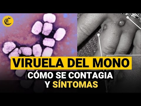 VIRUELA DEL MONO EN PERÚ: SÍNTONAS Y CONTAGIO | EXPLICADO