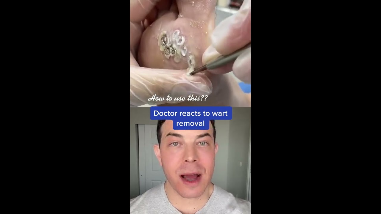 HUGE Plantar Wart Removal 208SkinDoc