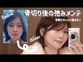 【美容整形】骨切り手術したらめっちゃ弛んだからメンテナンスしたら更に顔小さくなった【輪郭3点】