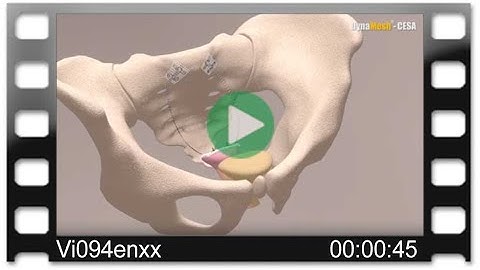 DynaMesh®-CESA - Animation: Cervicosacropexy - Bilateral Fixation - Level Promontory