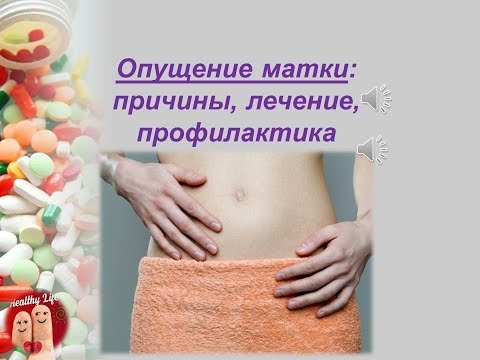 Опущение матки: причины, лечение и профилактика