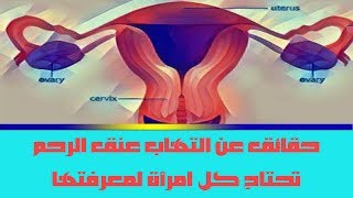 حقائق عن التهاب عنق الرحم تحتاج كل امرأة لمعرفتها