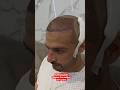 Hairtransplant super Chinese fue method Hairtransplant 7k+ grafts #hairtransplant #haircare #hair