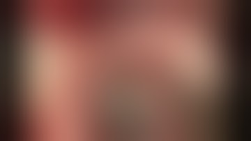 Giant MCA aneurysm - clipping operative video