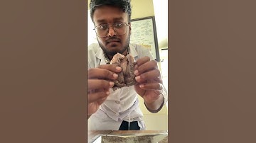 urinary bladder #health #disease #medicaldoctor #treatment