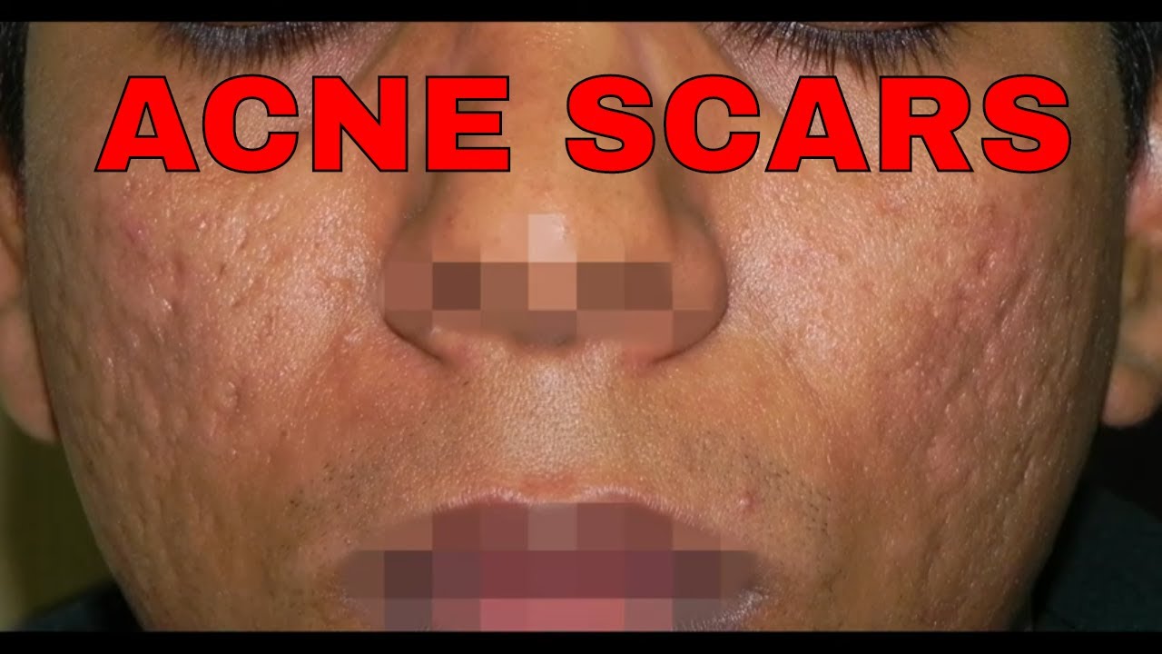acne scars multiple treatments acne scars multiple treatments
