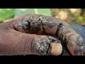 Oyundi&#39;s right hand -- SO MANY JIGGERS - see long video @riseupsociety.net ($10 to subscribe)