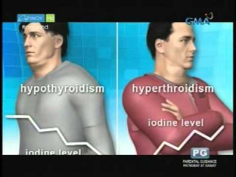 Video: Paano Mawalan ng Timbang Sa Sakit sa Thyroid (na may Mga Larawan)