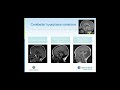 Solving Forgotten Disorders  Gene Discovery for Cerebellar Malformations Webinar
