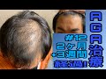 AGA治療開始2ヶ月+3週間経過！やはり比較は本当に大事ですね…！