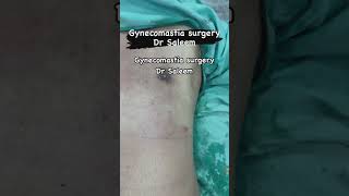 Gynecomastia surgery in Pakistan, lahore by dr Saleem. #gyno #gynecomastia #manboobsurgery