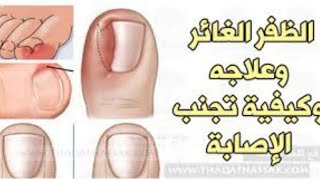 عملية ظفر غائر (غارز)..مش هيرجع للمريض تاني|دكتور احمد حسن جمعه