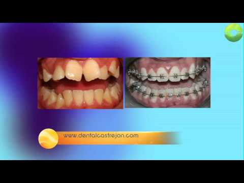 Dientes girados. Entrevista con el Dr. Alberto Castrejón, ortodoncista. ortodoncia mexicali