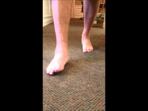 gait-after-triple-arthrodesis-surgery-for-pttd-sfism