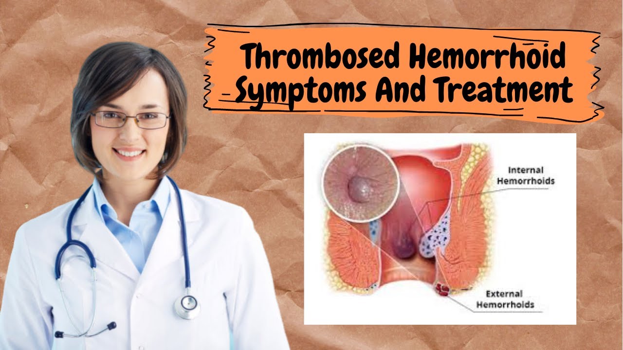 Treatment of thrombosed hemorrhoids