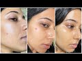 My Honest Morning Skincare Routine to remove Pimples &amp; Pimple Marks | unsponsored skincare