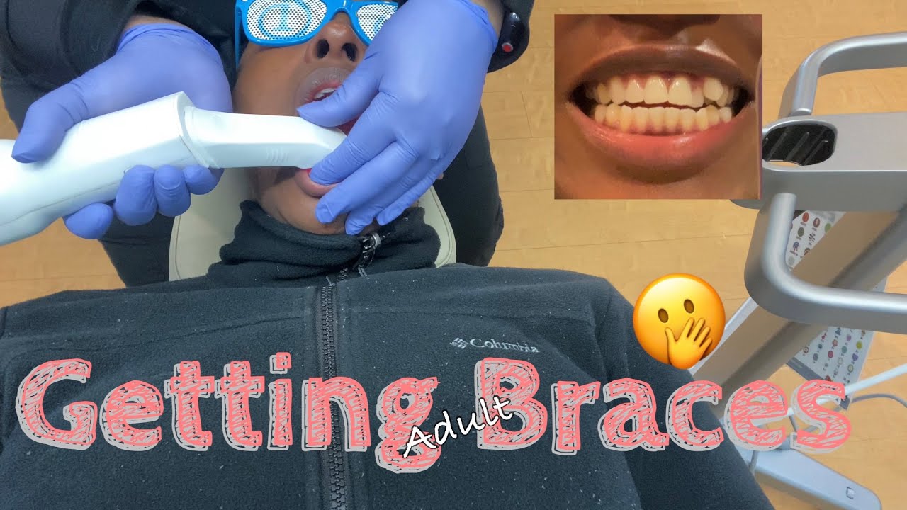 Getting Adult Braces First Week Adjusting Youtube 