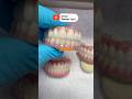 6 zirconia arches😉#dentist#dental#parati#fyp#reels#shorts#implant#yt#dentaltechnician#satisfying