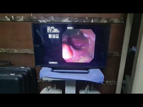 إحترس من زوائد القولون لأنها البداية لحدوث ورم خبيث بالقولون التشخيص و العلاج بالمنظار