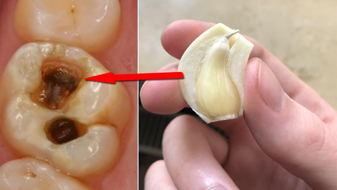 1 ही बार में दांत का दर्द और दांत का कीड़ा खत्म करने का कारगर देशी उपाय