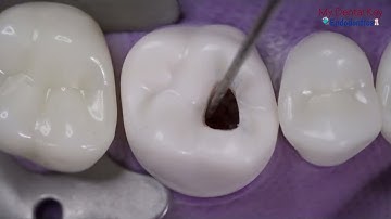 CDCA Exam Endo 14 Acces