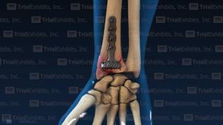 3D Solution for Wrist X-Ray Film Comparison