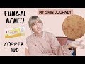 my skin journey | HORMONAL + FUNGAL ACNE
