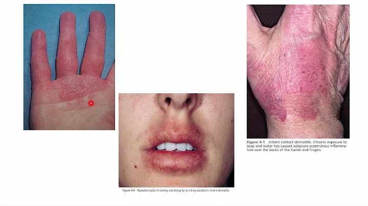 Dermatotogy/5th stage/Eczema & Dermatitis/Dr. Inti...