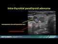 Parathyroid ultrasound when, why and how to do it? (Gerasimos Sykiotis)