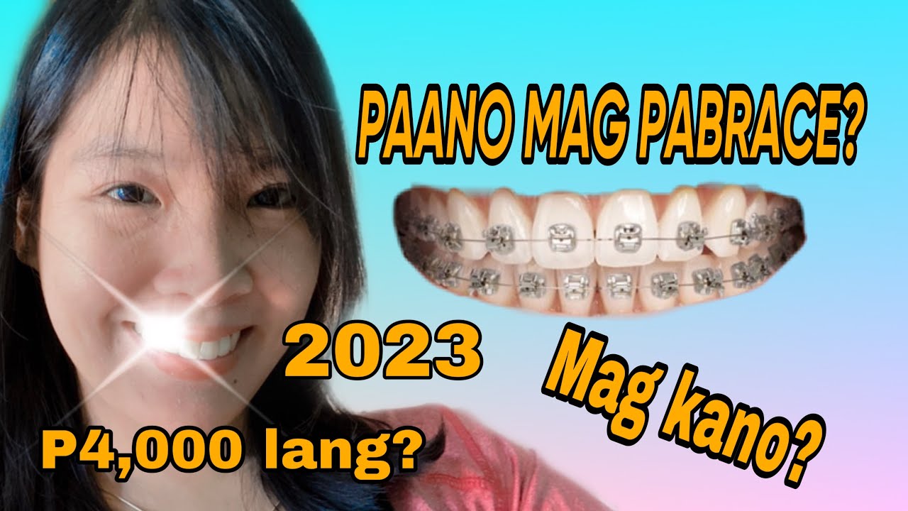 STEPBYSTEP KUNG PAANO MAG PA BRACE. MAG KANO MAG PA BRACE? (P4,000 DP) braces dentalbraces